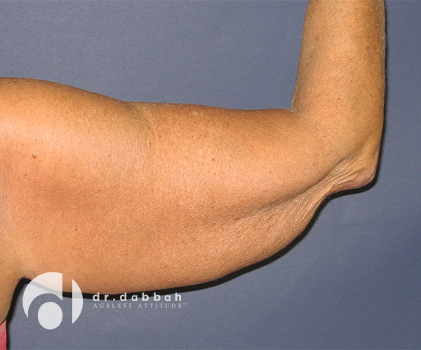 before armlift right arm back view female patient case 2548