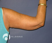 after armlift right arm back view female patient case 2548
