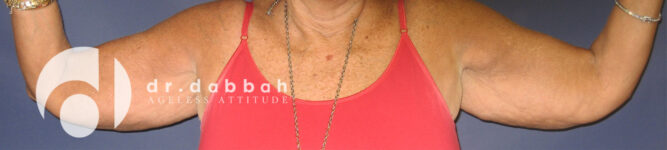 before armlift front view female patient case 2548