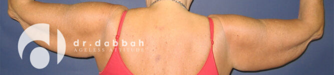 before armlift back view female patient case 2548