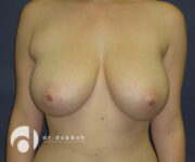 before breast lift with implants front view case 2525