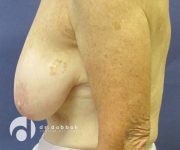before breast lift with implants left view case 2536