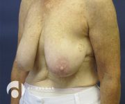 before breast lift with implants left angle view case 2536