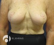 after breast lift with implants front view case 2536