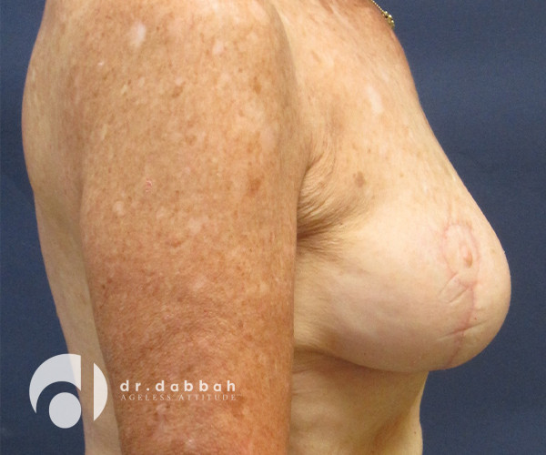 after breast lift with implants right view case 2536