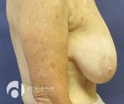 before breast lift with implants right view case 2536
